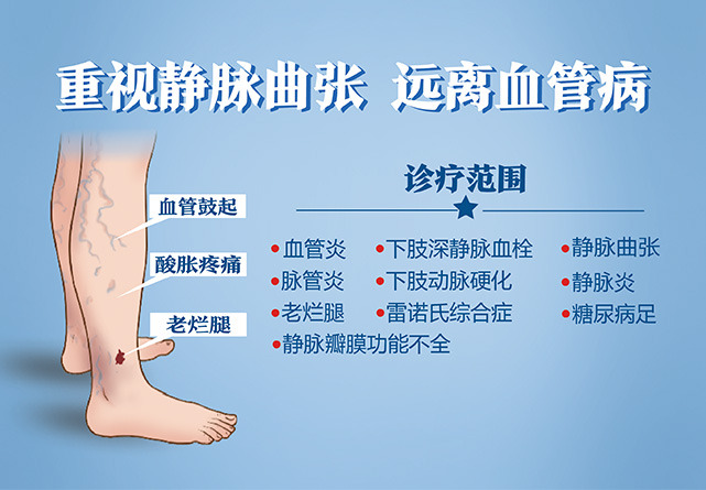 重视静脉曲张，远离血管病